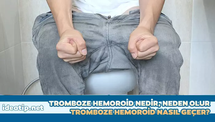 tromboze hemoroid nasıl geçer